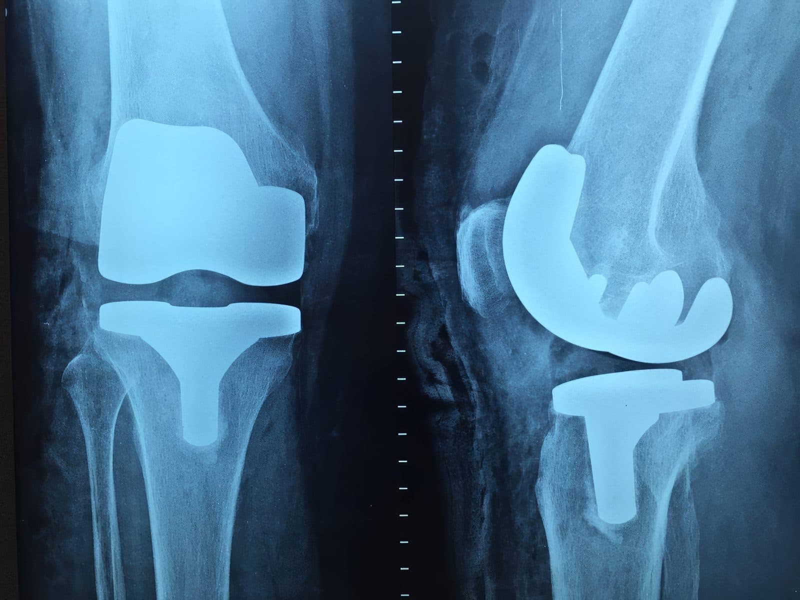 An X-ray of a knee after total knee replacement surgery
